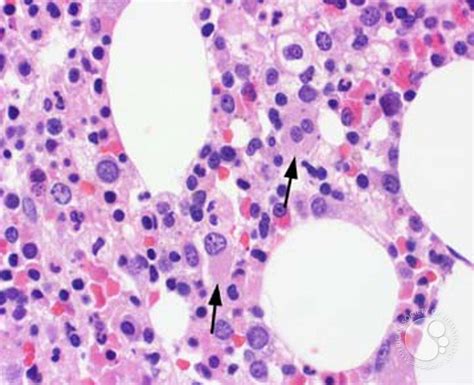 Myeloid Neoplasms. Myelodysplastic Syndrome: Refractory Ctyopenia with ...