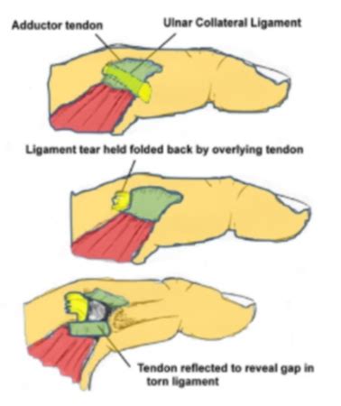 6. Stener Lesion