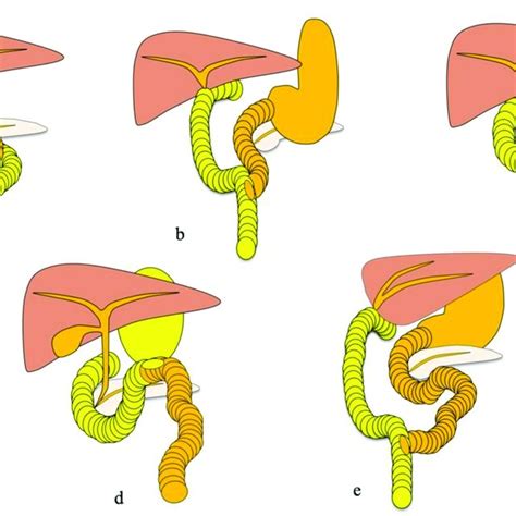 Operative procedures: (a) Roux-en-Y hepaticojejunostomy; (b) status... | Download Scientific Diagram