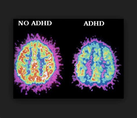 Does poor motivation or 'bad parenting' cause ADHD? Studies say it's in the brain structure ...