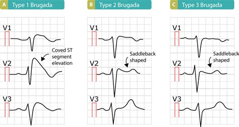 ST segment elevation in acute myocardial ischemia and differential diagnoses – ECG & ECHO