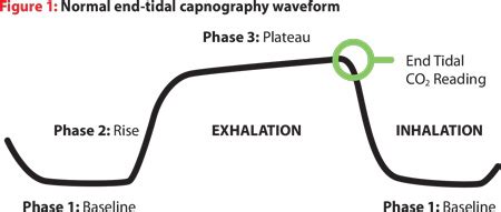 How to Read and Interpret End-Tidal Capnography Waveforms