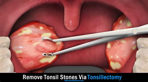 Tonsil Stones Removal Guide [2022]