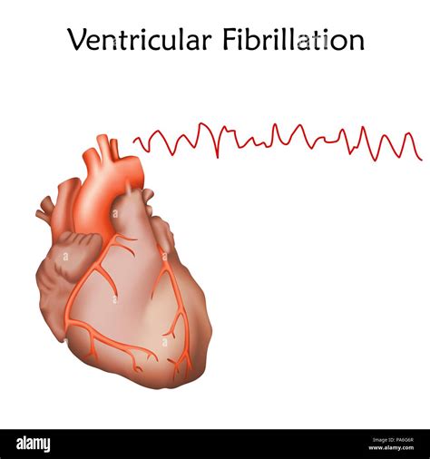 Ventricular Fibrillation