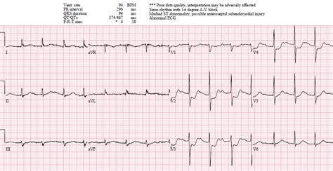 Posterior Wall Mi Is Best Identified in Which Leads - JaggerkruwSexton