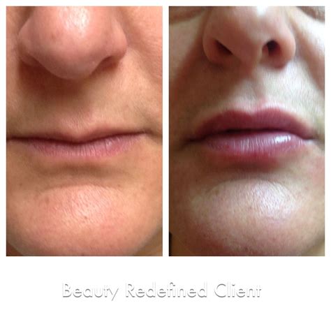 Do you know the difference Juvederm XC can make? With one syringe we can give your lips the ...