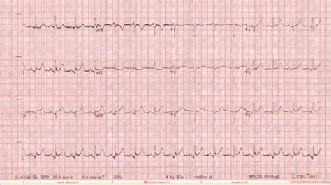 Life-Threatening Coronary Vasospasm Treated by Implantable Cardioverter ...