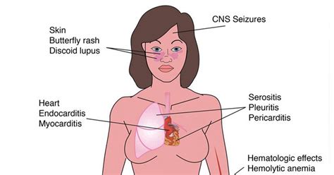 8 Natural Remedies to Reduce Lupus Flare Ups - Just Naturally Healthy