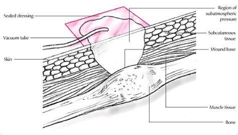 Nurse Base: UNDERSTANDING VACUUM-ASSISTED CLOSURE THERAPY