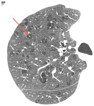 Decreased Lung Attenuation: Emphysema, Mosaic Perfusion, and Cystic Lung Disease | Radiology Key