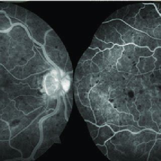 Fundus fluorescein angiography images of the patient. | Download Scientific Diagram