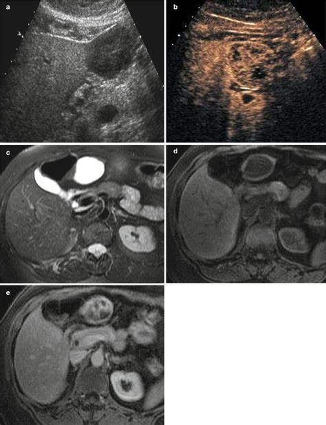 Benign Liver Tumors | Radiology Key