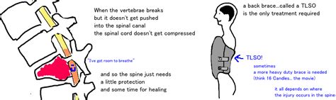 Spine - Burst Fracture — Bone Talks