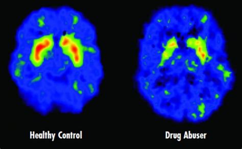 Effects of Alcohol on the Brain | AlcoholAwareness.org