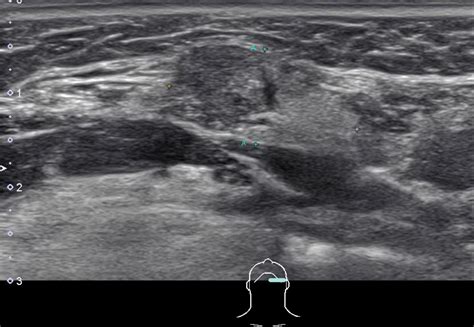 Chronic Submandibular Gland Sialadenitis: Case Example | Iowa Head and ...