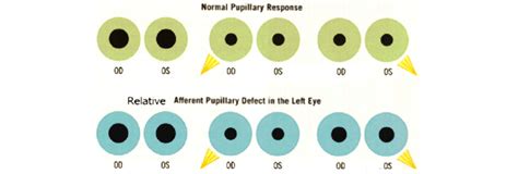 Afferent Pupillary Defect Pathway