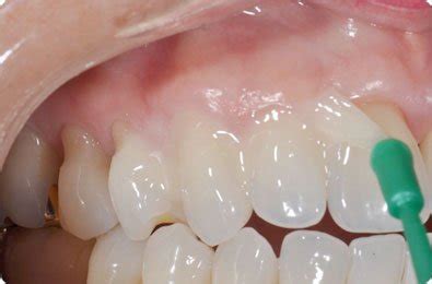 Fluoride Treatment | Shinagawa Orthodontics Philippines