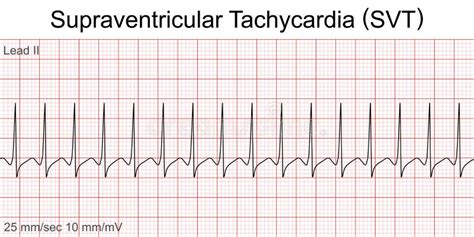 Electrocardiograma Muestra Taquicardia Supraventricular Patrón Svt ...