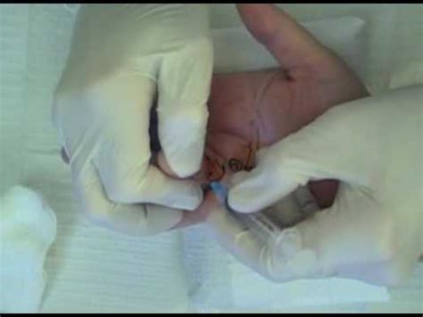 Fasciectomy vs Needle Fasciotomy - YouTube