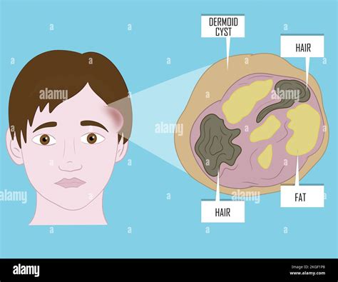 Dermoid Cyst Ovary Eye