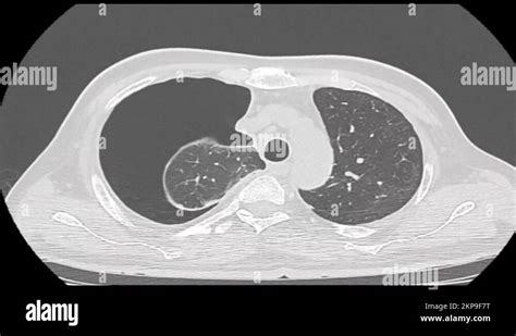 Pneumothorax, CT scan Stock Video Footage - Alamy