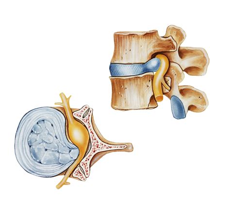 Nerve Root Encroachment and Decompression Surgery