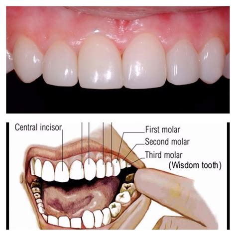 Wisdom Teeth Function – Boston Dentist – Congress Dental Group 160 ...