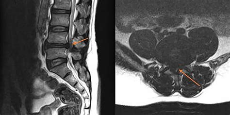 Case 2 Lumbosacral spine MRI (sagittal and axial T2 images) showed... | Download Scientific Diagram