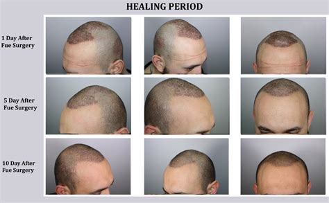 Fue Hair Transplant Technique