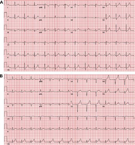 A: Baseline 12-lead electrocardiogram (ECG) of case 1 before... | Download Scientific Diagram