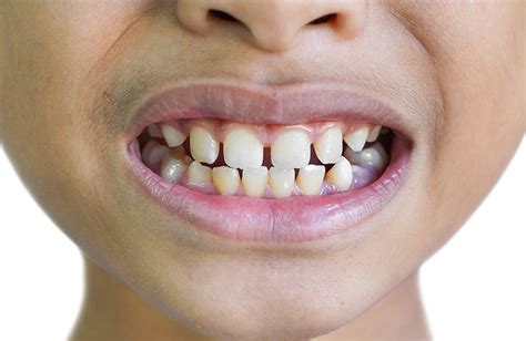 Should You Be Concerned About Gaps Between Teeth? - Hutto Hippo