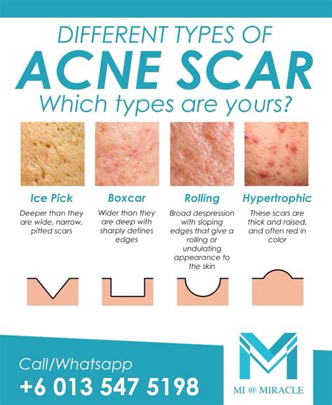 Acne Scar Removal | Miracle Skin Laser & Aesthetic Centre