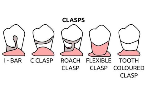 Types of clasps in RPD(Removable partial denture) - MEDizzy