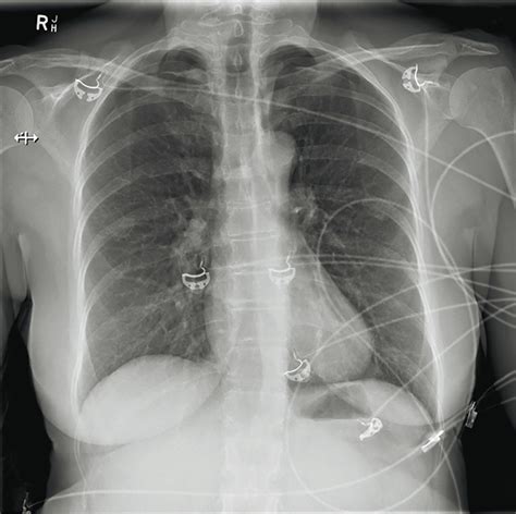 RACGP - An unusual cause of pleuritic pain