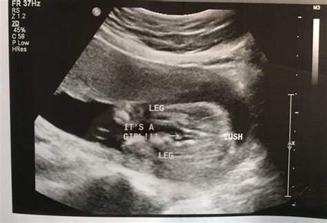 UPDATE-BOY!! 20 week ultrasound definitely a girl??? | BabyCenter