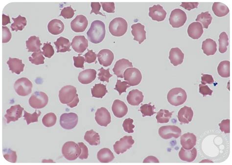 Acanthocytosis: a key feature for the diagnosis of abetalipoproteinemia