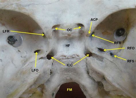 Photograph of the base of the skull showing confluent foramen ovale and ...