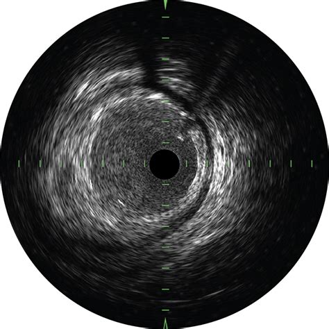 Clarispro™ HD-IVUS extended bandwidth catheter| Infraredx™ | Infraredx