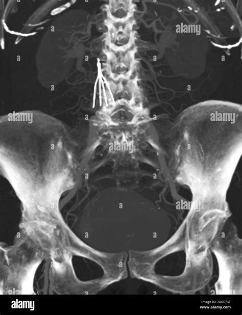 IVC filter implanted in abdomen. Combined 2D computed tomography (CT ...