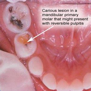 Reversible Pulpitis | Smiles for Life Oral Health