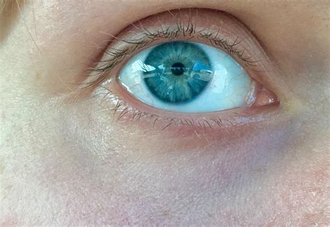 I have dysautonomia and my pupils can’t dilate : r/eyes