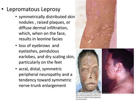 PPT - Leprosy PowerPoint Presentation, free download - ID:9499303