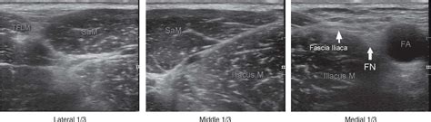 Ultrasound-Guided Fascia Iliaca Block | Anesthesia Key