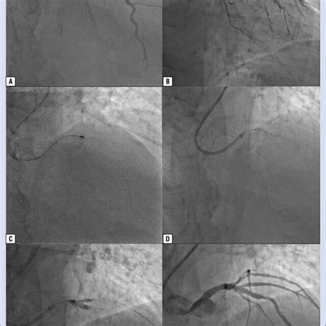 Coronary angioplasty of the left anterior descending artery using... | Download Scientific Diagram