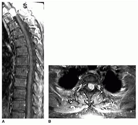 Techniques for Intradural Tumor Resection | Musculoskeletal Key