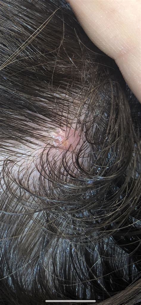 Bump on scalp that won't go away? : r/popping