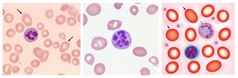 Laboratory Diagnosis of Megaloblastic Anemia (MBA)