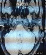 CT scan plain, left mastoid. | Download Scientific Diagram