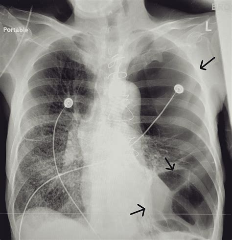 Cureus | Multiple Massive Bullae Formation Within Lung of SARS-CoV-2-Infected Patient