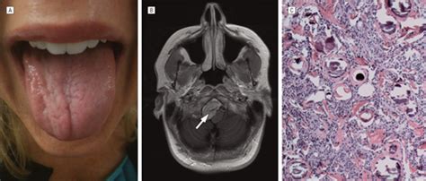 Unilateral Tongue Atrophy and Fasciculation | Neuro-oncology | JAMA Neurology | JAMA Network